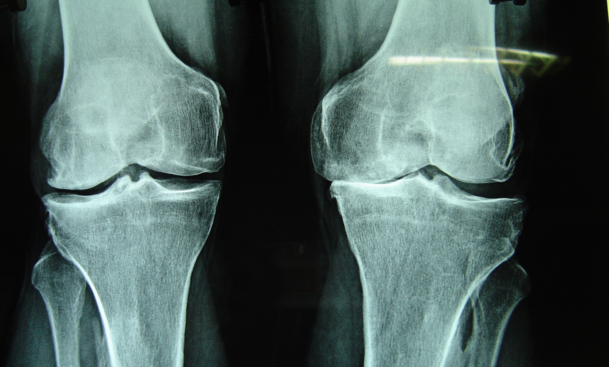  X-ray Of Normal (Left) and Abnormal (Right) knee